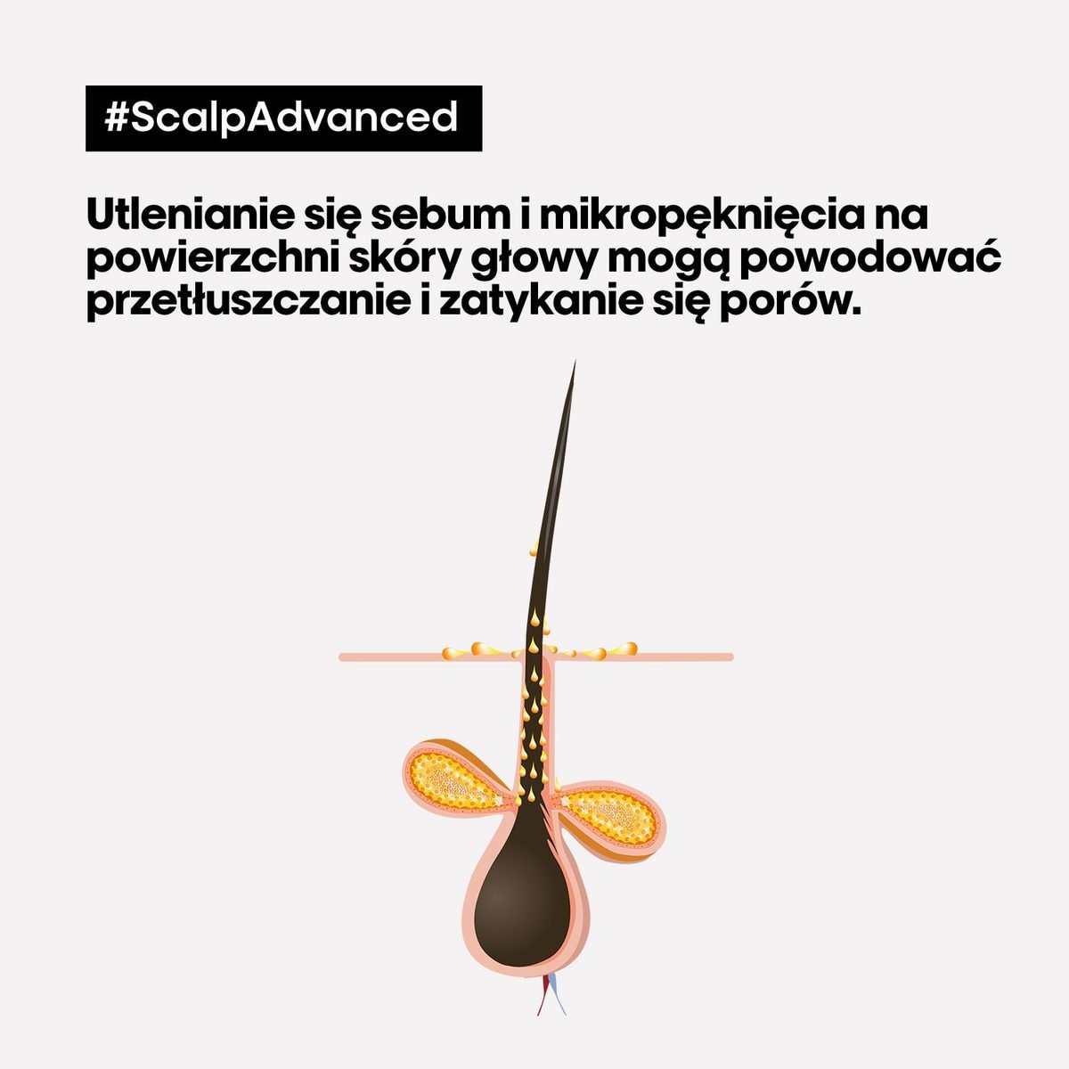Schemat mieszka włosowego z łojem i zatkanym ujściem, na białym tle edukacyjnym.
